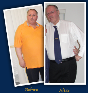 Sleeve Gastrectomy Before & After Photos FL